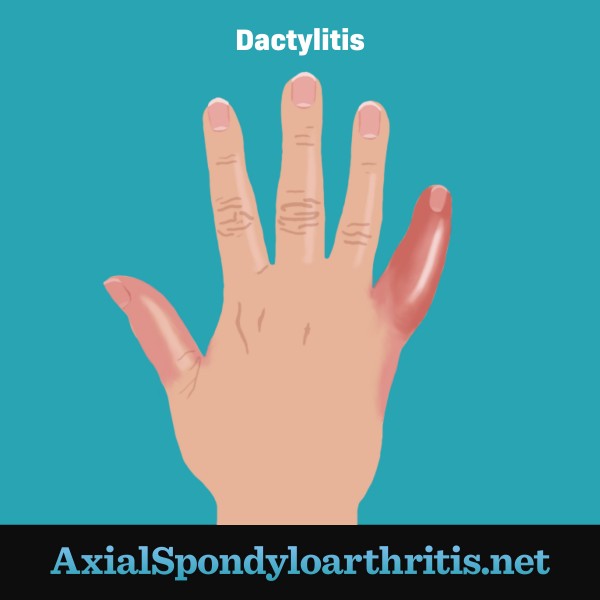 Sausage Digit (Dactylitis) | AxialSpondyloarthritis.net