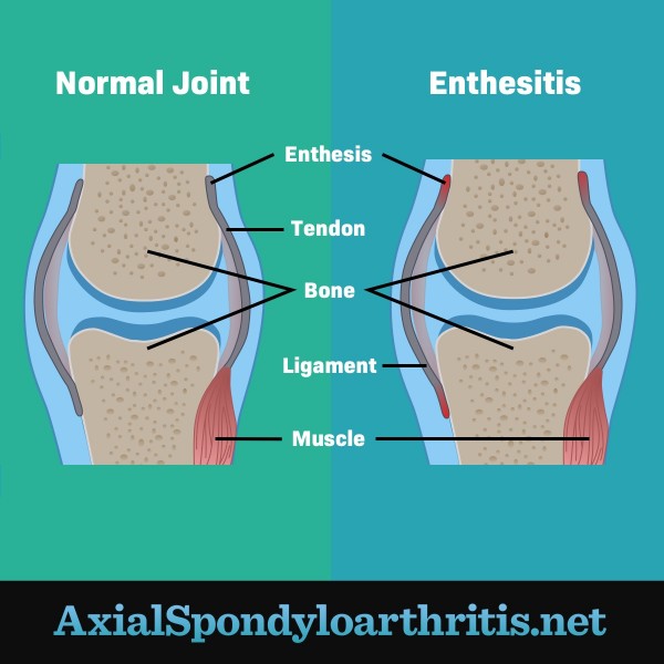 A normal joint next to a joint with enthesitis showing red inflammation and swelling.