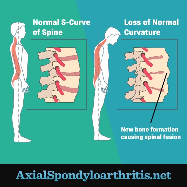A normal spine next to a spine that has lost normal curvature due to bone formation between the vertebrae, showing progression of axial spondyloarthritis.