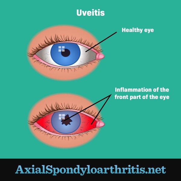 A normal eye next to an eye with uveitis that appears red and inflamed with a distorted pupil.